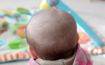 4个月大的婴儿快速脱发