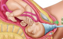 当您进行腹腔分娩时会发生什么