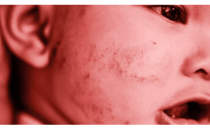 如何从其他皮肤病中辨别宝宝脸上的热疹