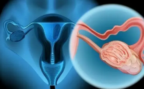 ESHRE发布关于子宫内膜异位症诊断和治疗的新指南