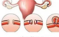 2月26日研究表明宫内节育器在预防怀孕方面至少与输卵管结扎一样有效