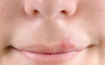 唇疱疹通过与唇印但明显的孩子的人分享食物或亲吻来感染病毒