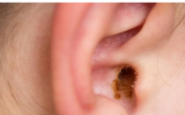 耳垢的作用是保护如纸道的耳膜和耳膜的提醒和宣传的一个事件
