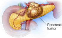 研究人员确定了治疗胰腺癌的潜在基因标志物