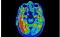 阿尔茨海默氏症为何会损害大脑部分的新线索