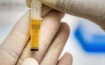 尿液中的生物标志物可能是第一个揭示早期阿尔茨海默病的生物标志物