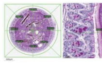 科学家强调有害肠道细菌在癌症患者发烧中的作用