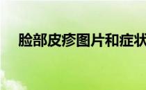 脸部皮疹图片和症状（皮疹图片和症状）