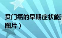 贲门癌的早期症状能治好吗（贲门癌早期胃镜图片）