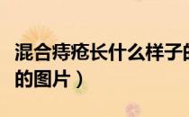 混合痔疮长什么样子的图片（痔疮长什么样子的图片）